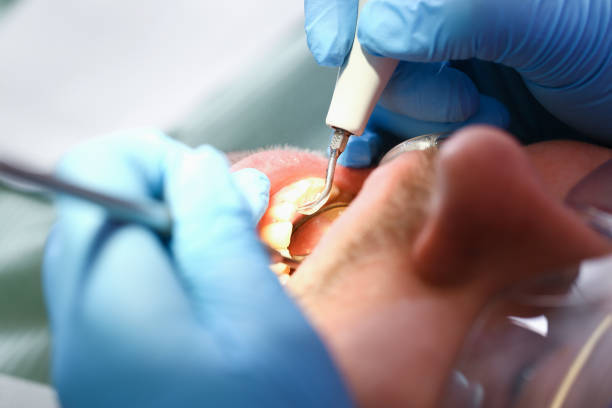 Best Emergency Treatment for Dental Infections or Abscesses in Glencoe, AL